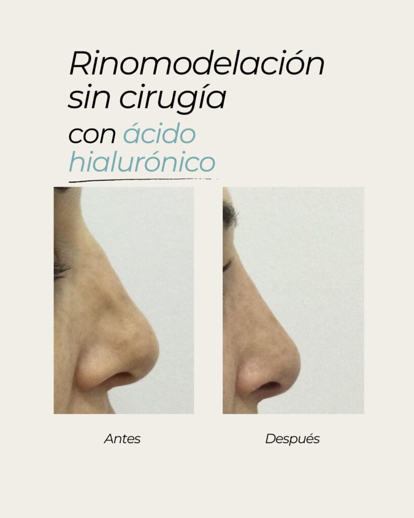 rinomodelacion de la nariz sin cirugía en sevilla y alcala de guadaira